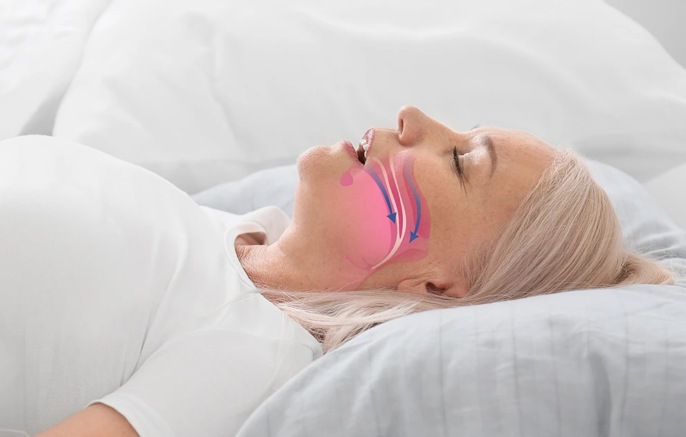 What is sleep apnea?